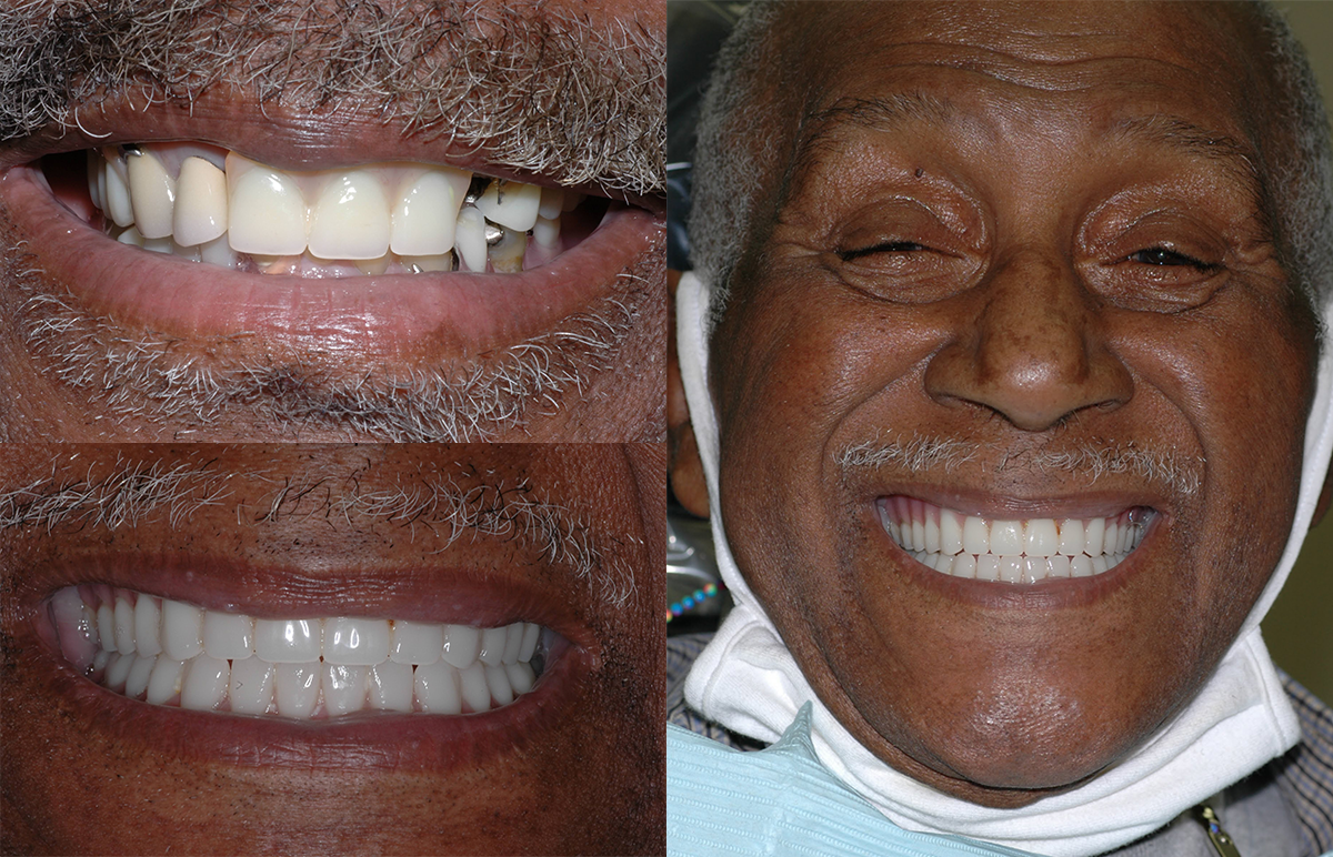 Implant Supported Dentures Before & After