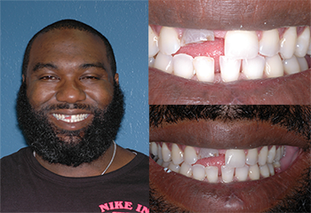 Front Discolored Tooth Before