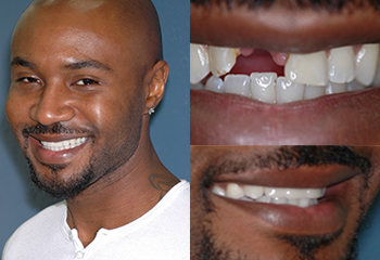 Dental Bridge Before and After