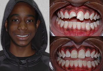 Brooken Front Tooth Before and After