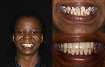 Cosmetic Smile Enhancement Before and After