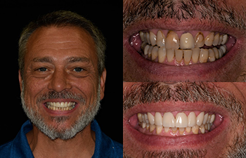 Smile Enhancement Before and After