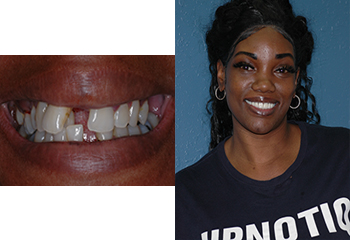Implant Supported Denture Before and After