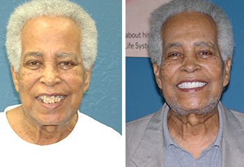 Smile Enhancement w/ Dentures Before and After