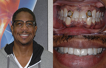 Smile Enhancement w/ Veneers before and after